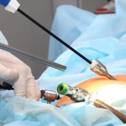 Laser Surgery for piles, fissures, and fistulas