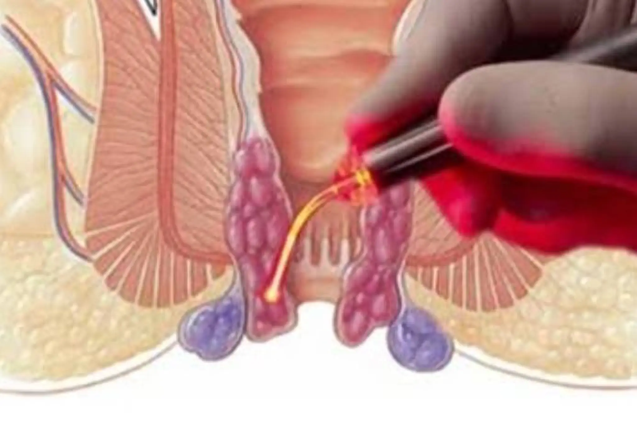 Laser Piles Treatment in Pune