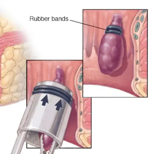 Rubber Band Ligation for early-stage hemorrhoids