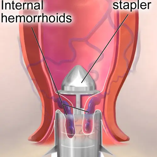 Stapler Surgery for advanced piles